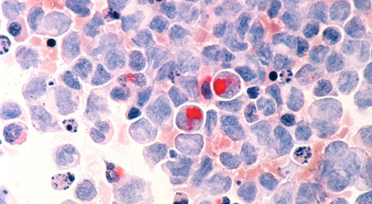 هدف قرار گرفتن سلول‌های عامل عود سرطان خون برای درمان با سلول‌های CAR T 